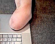 Amputations1